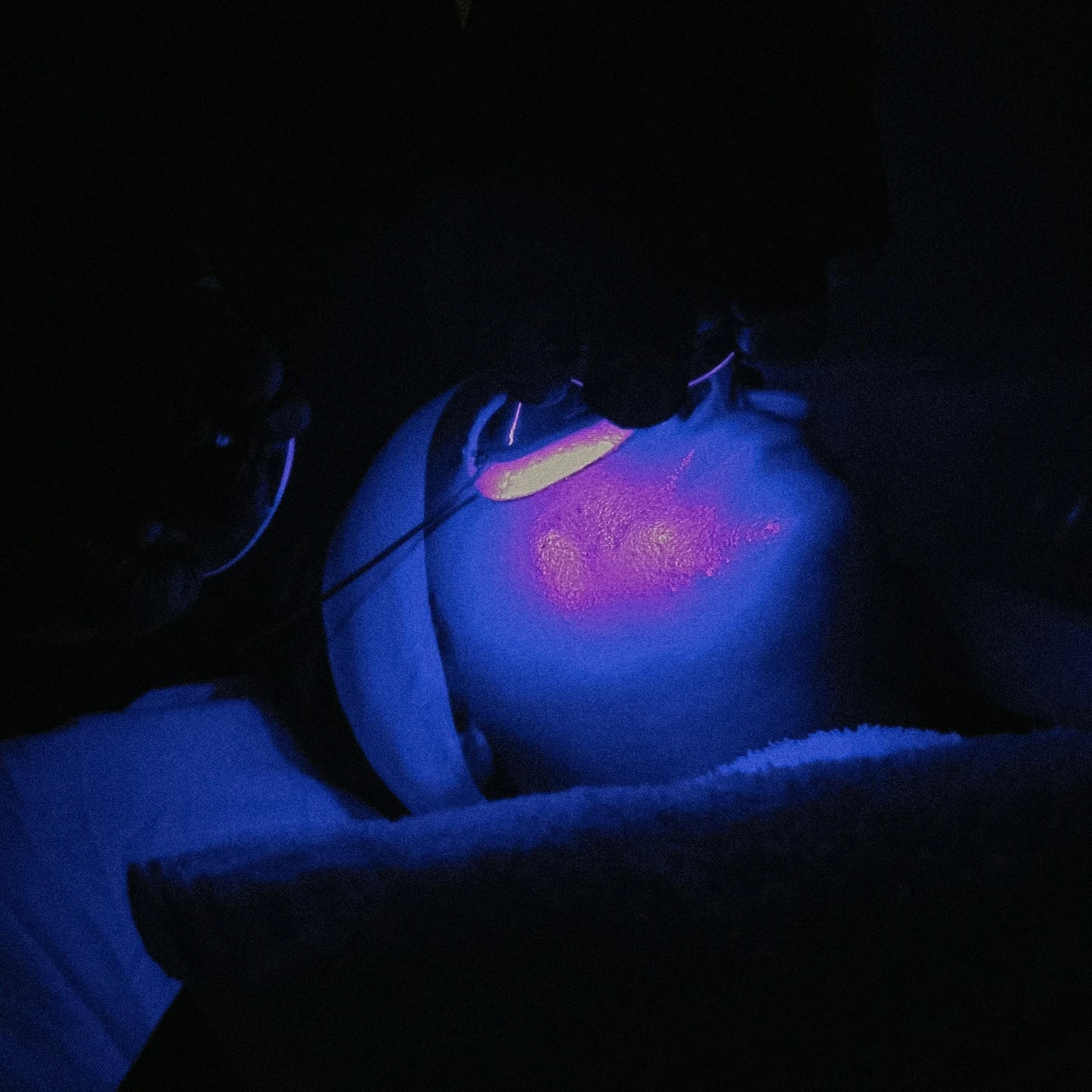Wood's lamp examination revealing fungal infection on patient's skin with fluorescent pink and blue highlighting